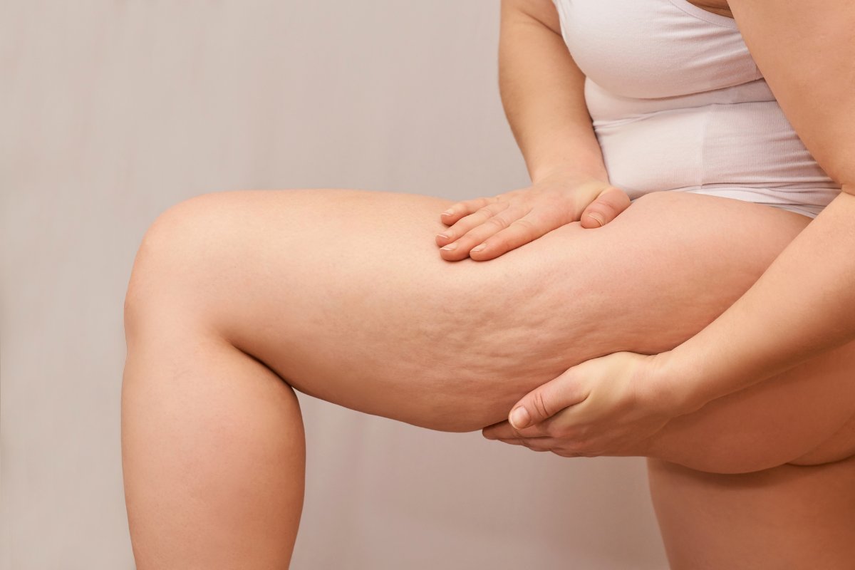 indiba celulitis resultados